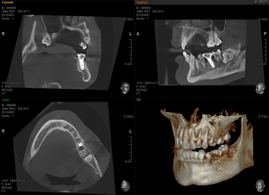 歯科用アーム型X線CT診断装置『プレビスタ フレックス3D』導入！