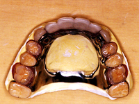 コーヌス義歯・磁性アタッチメント