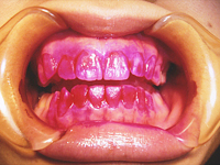 1.歯質に浸透しやすい
