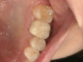 タコシェルラミネート。舌側、唇側の被覆